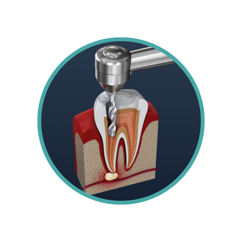 Root Canal Treatment