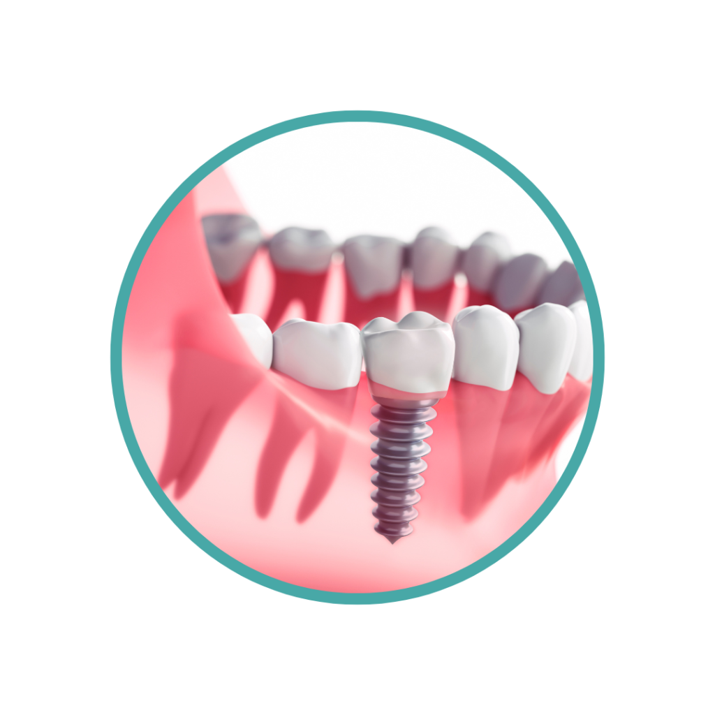 Dental Implants